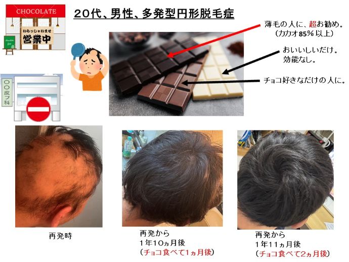 円形脱毛症　病院